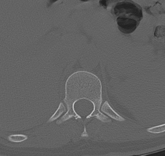 File:Normal lumbosacral CT (Radiopaedia 37923-39867 Axial bone window 10).png