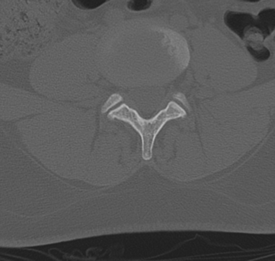 File:Normal lumbosacral CT (Radiopaedia 37923-39867 Axial bone window 67).png