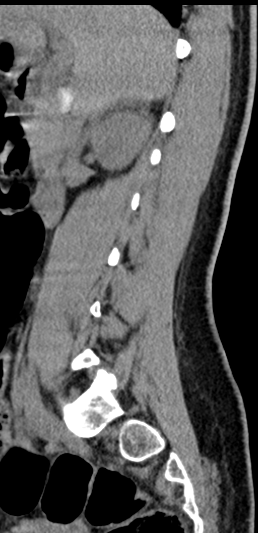 Normal lumbosacral CT (Radiopaedia 37923-39867 E 76).png