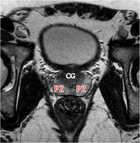 File:Normal prostate (MRI) (Radiopaedia 29986-30536 A 2).png