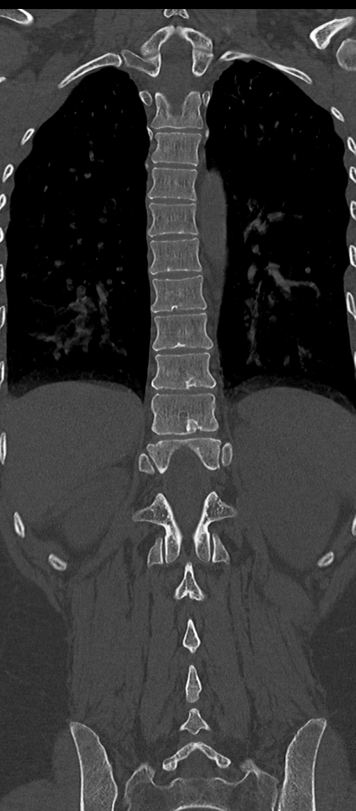 Normal thoracolumbar spine (Radiopaedia 43822-47309 Coronal bone window 60).png