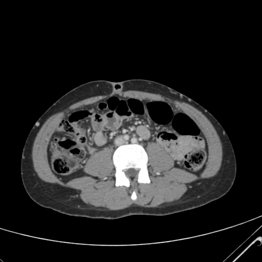 File:Nutmeg liver- Budd-Chiari syndrome (Radiopaedia 46234-50635 B 40).png