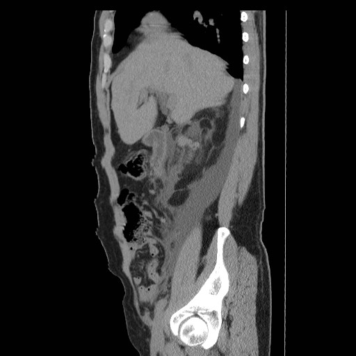File:Obstructed kidney with perinephric urinoma (Radiopaedia 26889-27066 B 15).jpg