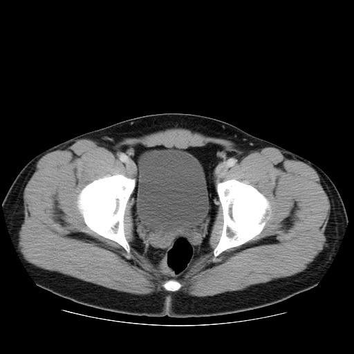 File:Obstructing ureteric calculus (Radiopaedia 18615-18514 B 52).jpg