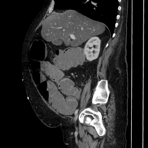 Obstructive colonic diverticular stricture (Radiopaedia 81085-94675 C 90).jpg