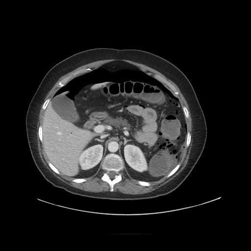 Obstructive distal colonic adenocarcinoma causing cecal perforation (Radiopaedia 86830-102989 A 62).jpg