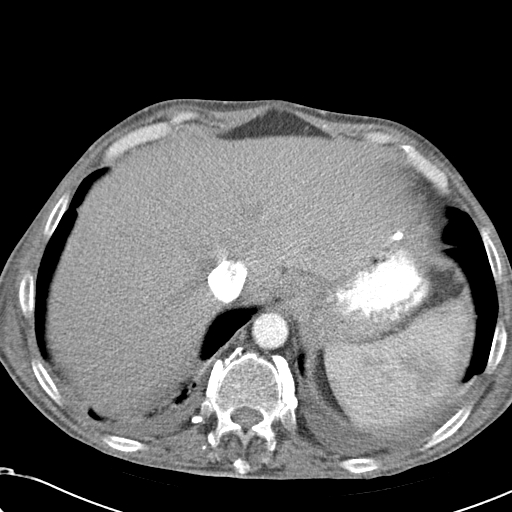 File:Obstructive superior vena cava tumor thrombus (Radiopaedia 28046-28306 A 48).jpg