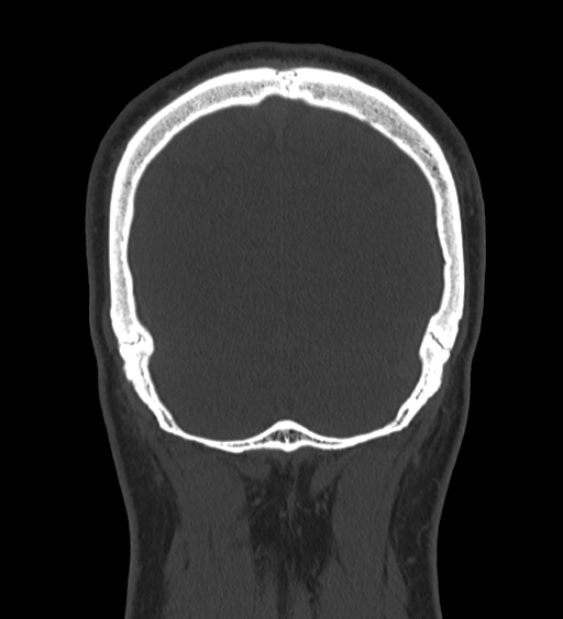 Occipital spur and Currarino type A atlas anomaly (Radiopaedia 87027-103285 Coronal bone window 121).jpg