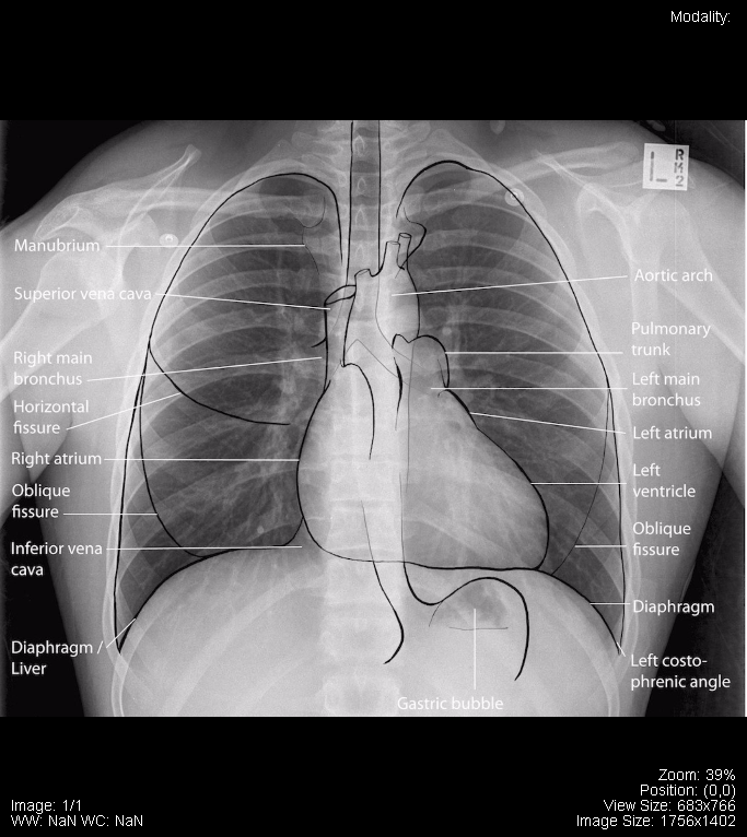 PA Chest x-ray labelled.png