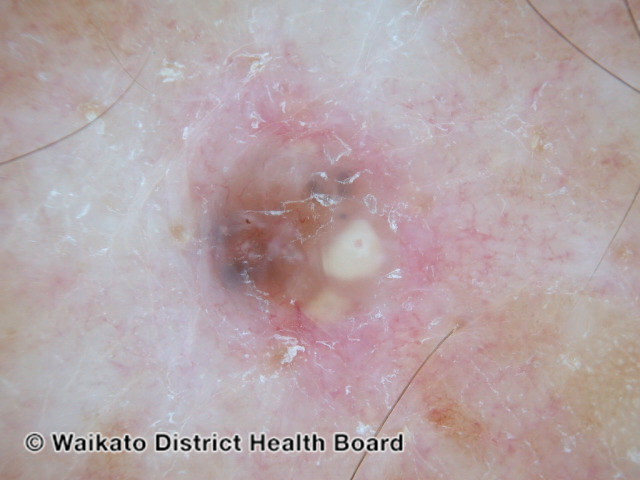 File:Pigmented basal cell carcinoma dermoscopy (DermNet NZ pbcc-wdhb).jpg
