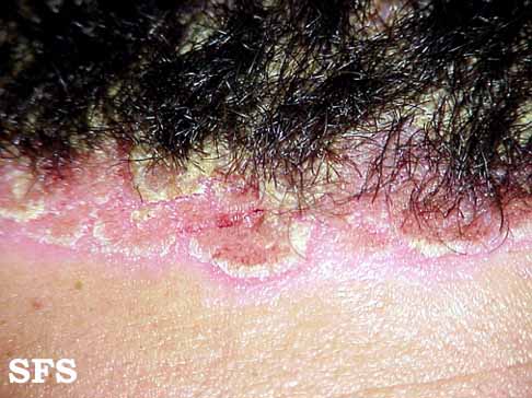 File:Psoriasis (Dermatology Atlas 14).jpg