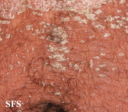 File:Psoriasis (Dermatology Atlas 81).jpg