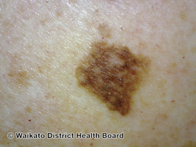 File:Superficial spreading melanoma in situ (DermNet NZ melanoma-abcd-12).jpg