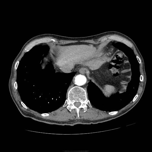Abdominal aortic aneurysm (Radiopaedia 13341-13340 Axial C+ arterial phase 15).jpg