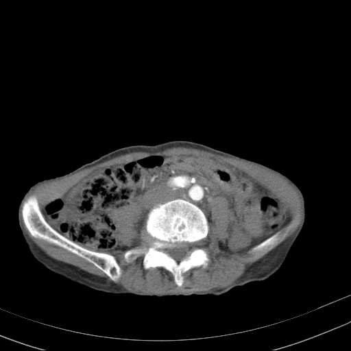 File:Abdominal aortic aneurysm (Radiopaedia 20827-20742 Axial C+ arterial phase 22).jpg