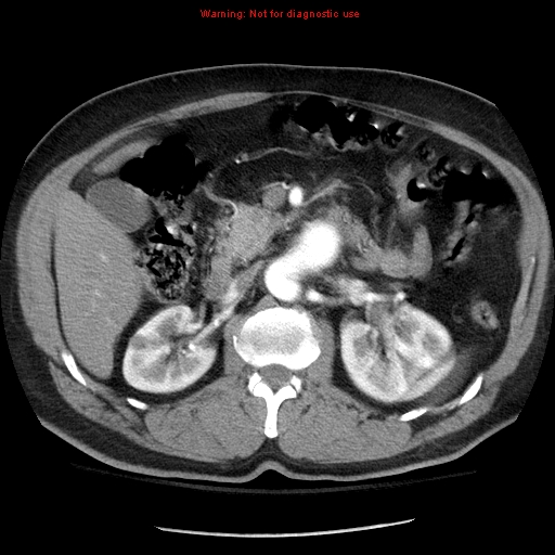 Abdominal aortic aneurysm (Radiopaedia 8190-9038 Axial C+ arterial phase 31).jpg