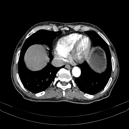 Abdominal aortic aneurysm (Radiopaedia 83581-98689 Axial C+ arterial phase 12).jpg