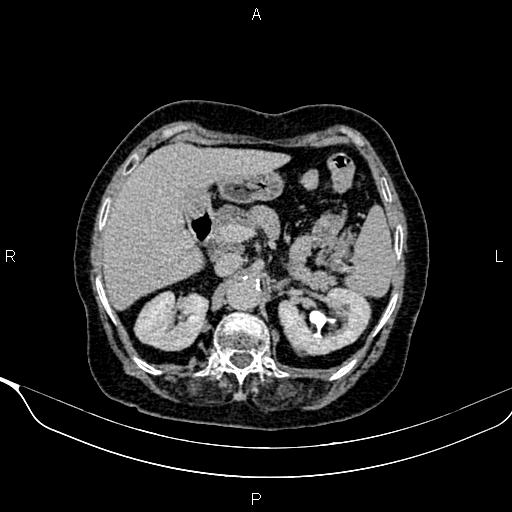 Abdominal aortic aneurysm (Radiopaedia 85063-100606 Axial C+ delayed 25).jpg