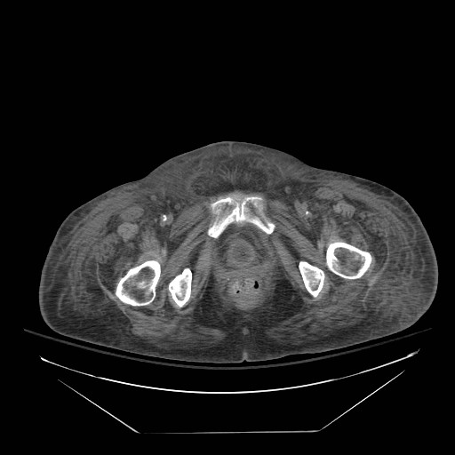 Abdominal aortic aneurysm - impending rupture (Radiopaedia 19233-19247 Axial non-contrast 167).jpg