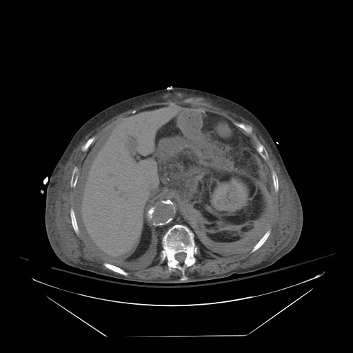Abdominal aortic aneurysm - impending rupture (Radiopaedia 19233-19247 Axial non-contrast 50).jpg
