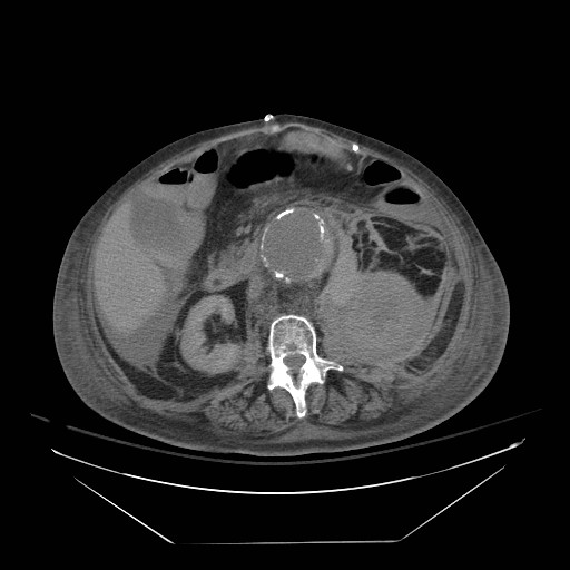Abdominal aortic aneurysm - impending rupture (Radiopaedia 19233-19247 Axial non-contrast 84).jpg