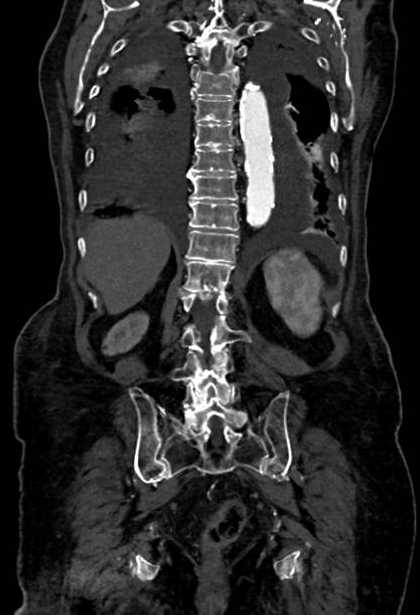 Abdominal aortic aneurysm with thrombus fissuration (Radiopaedia 73192-83919 Coronal C+ arterial phase 70).jpg