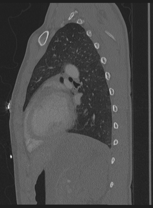 Abdominal multi-trauma - devascularised kidney and liver, spleen and pancreatic lacerations (Radiopaedia 34984-36486 Sagittal bone window 10).png