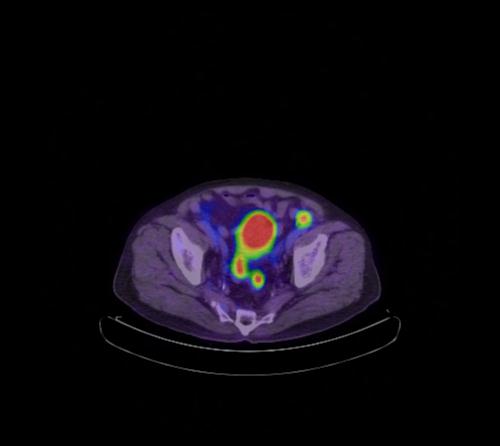 Abdominal wall metastasis from colorectal carcinoma (Radiopaedia 31016-31719 Axial 33).jpg