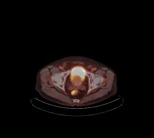 Abdominal wall metastasis from colorectal carcinoma (Radiopaedia 31016-31719 C 26).jpg