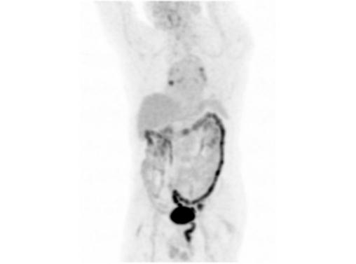 File:Abdominal wall metastasis from colorectal carcinoma (Radiopaedia 31016-31719 Rotational MIP 3).jpg