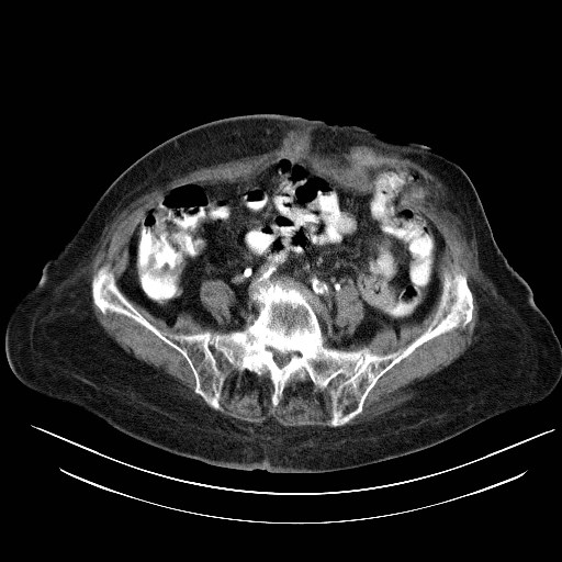 File:Abdominal wall recurrence after colorectal resection for cancer (Radiopaedia 23444-23523 Axial C+ portal venous phase 25).jpg