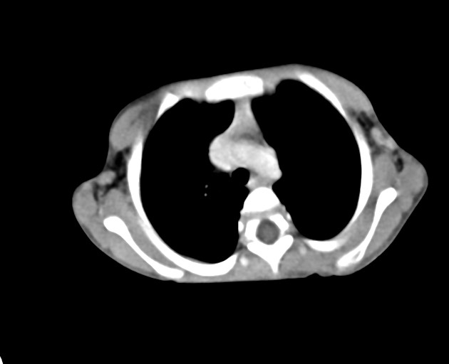 Abdominopelvic rhabdomyosarcoma (Radiopaedia 78356-90984 Axial C+ portal venous phase 10).jpg