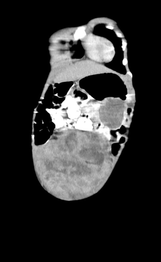 Abdominopelvic rhabdomyosarcoma (Radiopaedia 78356-90984 Coronal C+ portal venous phase 14).jpg