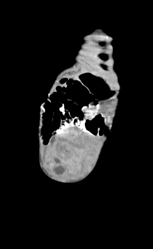 Abdominopelvic rhabdomyosarcoma (Radiopaedia 78356-90984 Coronal C+ portal venous phase 9).jpg