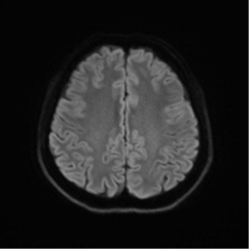 Abducens nerve palsy (Radiopaedia 51069-56648 Axial DWI 46).png