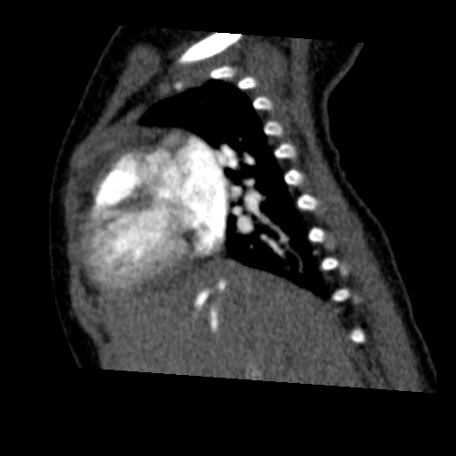 Aberrant left pulmonary artery (pulmonary sling) (Radiopaedia 42323-45435 Sagittal C+ arterial phase 18).jpg
