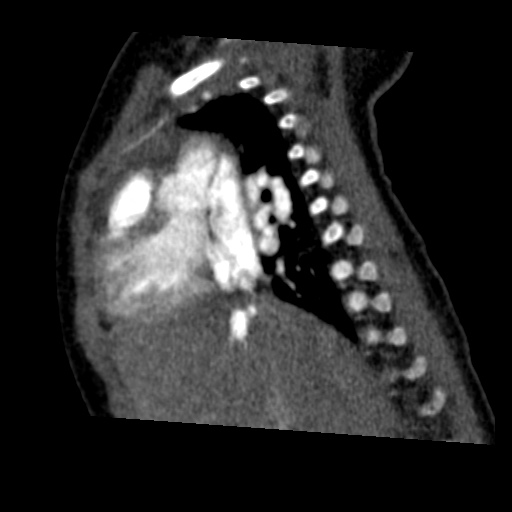 Aberrant left pulmonary artery (pulmonary sling) (Radiopaedia 42323-45435 Sagittal C+ arterial phase 20).jpg