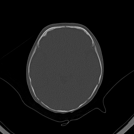 File:Accessory intraparietal suture (Radiopaedia 50584-56020 Axial bone window 19).jpg