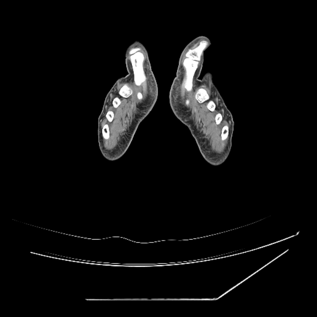Accessory soleus muscle (Radiopaedia 61069-68943 Axial non-contrast 97).jpg
