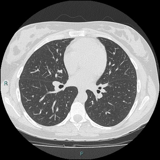 File:Accidental foreign body aspiration (seamstress needle) (Radiopaedia 77740-89983 Axial lung window 36).jpg