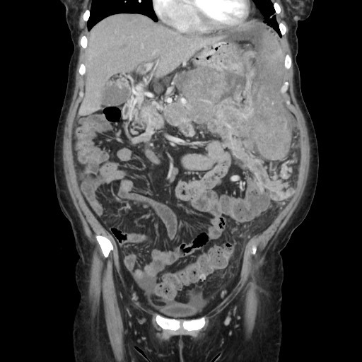 Acinar cell carcinoma of the pancreas (Radiopaedia 75442-86669 Coronal C+ portal venous phase 44).jpg
