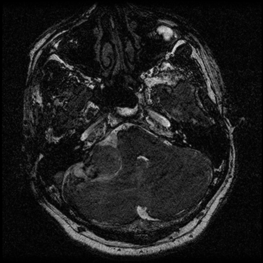 File:Acoustic schwannoma (Radiopaedia 39170-41387 Axial FIESTA 58).png
