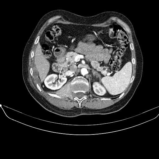 File:Acquired adrenal hyperplasia - due to thymic carcinoid tumor (Radiopaedia 21269-21184 C+ arterial phase 39).jpg