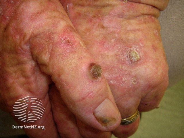 File:Actinic keratoses affecting the hands (DermNet NZ lesions-ak-hands-482).jpg