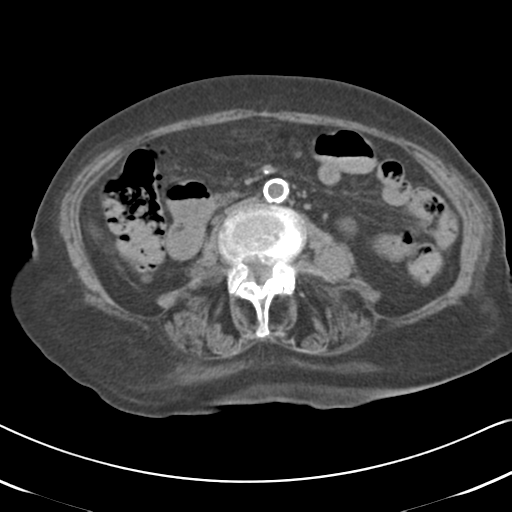 Active bleeding from duodenal ulcer with embolization (Radiopaedia 34216-35481 Axial non-contrast 32).png