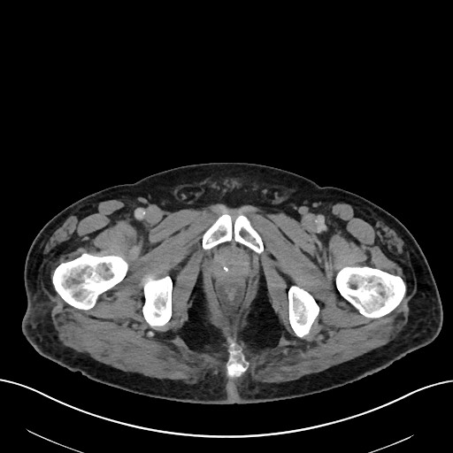 Active lower gastrointestinal bleeding - diverticular (Radiopaedia 61203-69106 Axial C+ portal venous phase 132).jpg