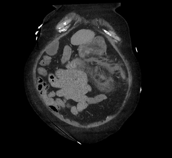 Active renal extravasation with large subcapsular and retroperitoneal hemorrhage (Radiopaedia 60975-68796 Coronal C+ arterial phase 35).jpg