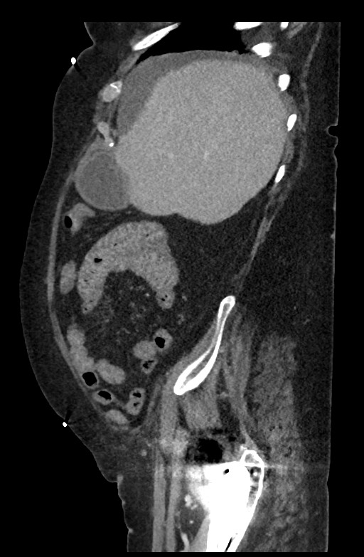 Active renal extravasation with large subcapsular and retroperitoneal hemorrhage (Radiopaedia 60975-68796 Sagittal C+ portal venous phase 171).jpg