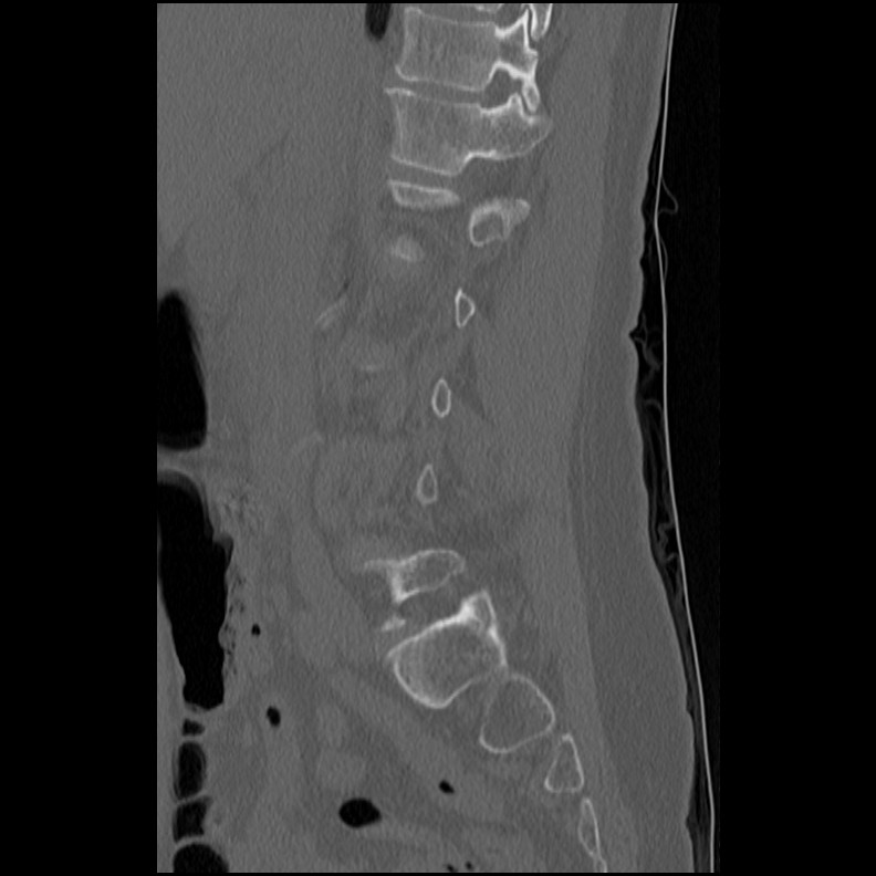 Acute Schmorl's node (Radiopaedia 83276-102365 Sagittal bone window 51).jpg