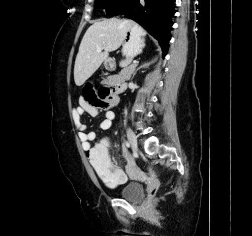 Acute appendicitis, heterotaxy syndrome (Radiopaedia 66884-76202 Sagittal C+ portal venous phase 60).jpg